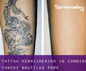 Tattoo verwijdering in Conning Towers-Nautilus Park