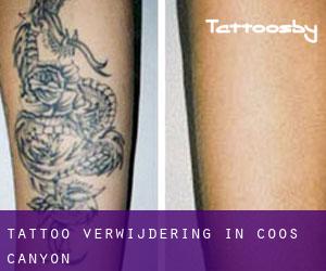 Tattoo verwijdering in Coos Canyon