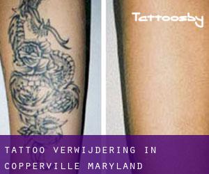Tattoo verwijdering in Copperville (Maryland)