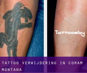 Tattoo verwijdering in Coram (Montana)
