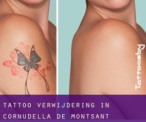 Tattoo verwijdering in Cornudella de Montsant