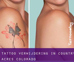 Tattoo verwijdering in Country Acres (Colorado)