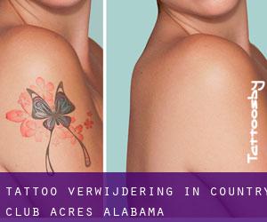 Tattoo verwijdering in Country Club Acres (Alabama)