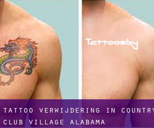 Tattoo verwijdering in Country Club Village (Alabama)