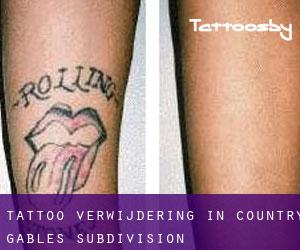 Tattoo verwijdering in Country Gables Subdivision