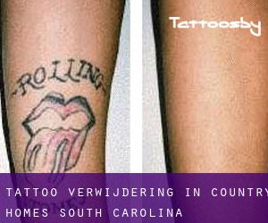 Tattoo verwijdering in Country Homes (South Carolina)