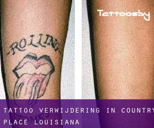 Tattoo verwijdering in Country Place (Louisiana)