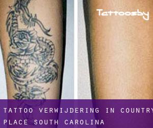 Tattoo verwijdering in Country Place (South Carolina)