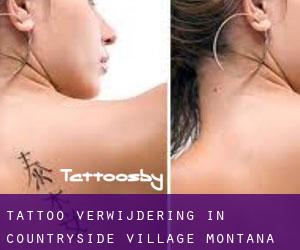 Tattoo verwijdering in Countryside Village (Montana)
