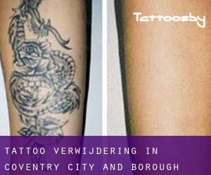 Tattoo verwijdering in Coventry (City and Borough)