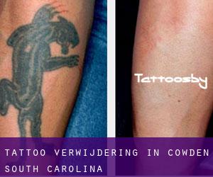 Tattoo verwijdering in Cowden (South Carolina)