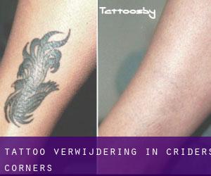 Tattoo verwijdering in Criders Corners