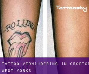 Tattoo verwijdering in Crofton West Yorks