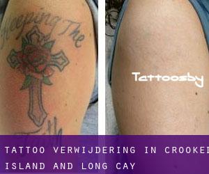 Tattoo verwijdering in Crooked Island and Long Cay