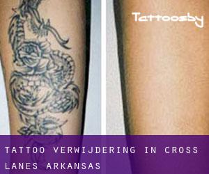 Tattoo verwijdering in Cross Lanes (Arkansas)