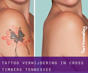 Tattoo verwijdering in Cross Timbers (Tennessee)