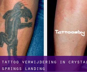 Tattoo verwijdering in Crystal Springs Landing