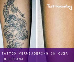 Tattoo verwijdering in Cuba (Louisiana)