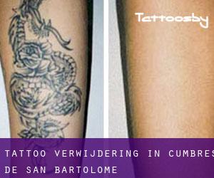 Tattoo verwijdering in Cumbres de San Bartolomé
