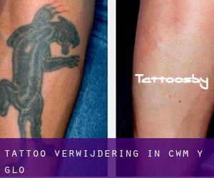 Tattoo verwijdering in Cwm-y-glo