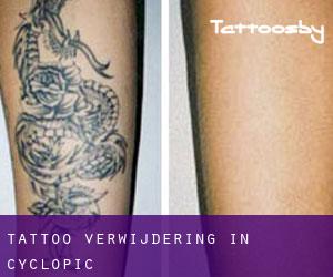 Tattoo verwijdering in Cyclopic