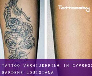 Tattoo verwijdering in Cypress Gardens (Louisiana)