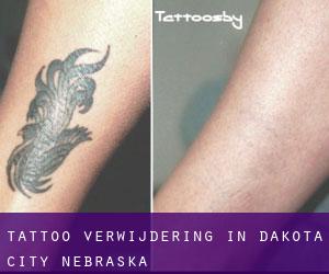 Tattoo verwijdering in Dakota City (Nebraska)
