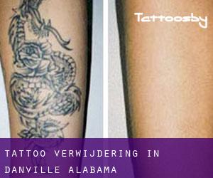 Tattoo verwijdering in Danville (Alabama)