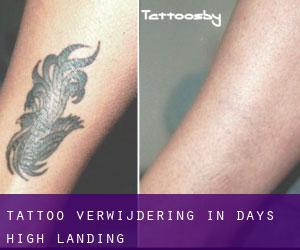 Tattoo verwijdering in Days High Landing