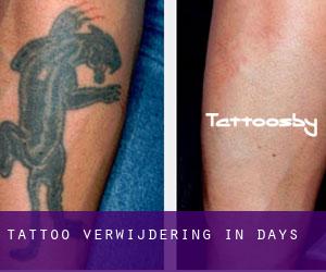 Tattoo verwijdering in Days
