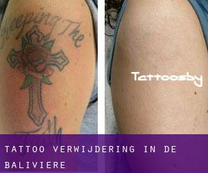 Tattoo verwijdering in De Baliviere