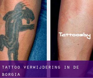 Tattoo verwijdering in De Borgia
