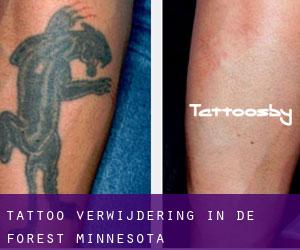 Tattoo verwijdering in De Forest (Minnesota)