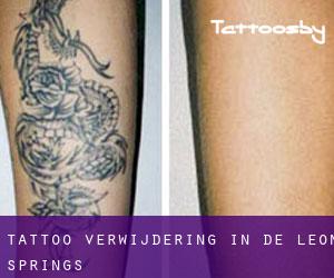 Tattoo verwijdering in De Leon Springs
