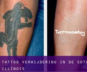 Tattoo verwijdering in De Soto (Illinois)