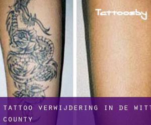 Tattoo verwijdering in De Witt County
