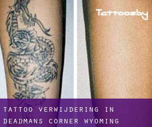 Tattoo verwijdering in Deadmans Corner (Wyoming)
