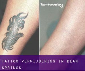 Tattoo verwijdering in Dean Springs