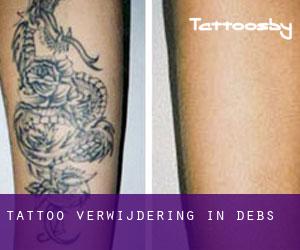 Tattoo verwijdering in Debs