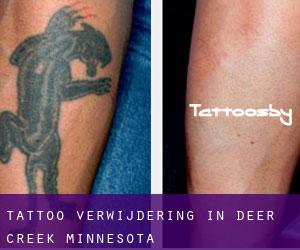Tattoo verwijdering in Deer Creek (Minnesota)