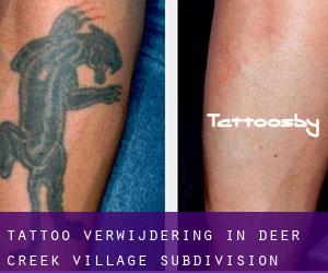 Tattoo verwijdering in Deer Creek Village Subdivision