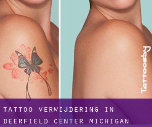 Tattoo verwijdering in Deerfield Center (Michigan)