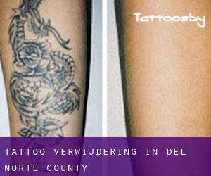 Tattoo verwijdering in Del Norte County