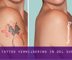 Tattoo verwijdering in Del Sur
