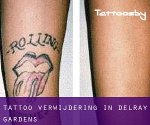 Tattoo verwijdering in Delray Gardens