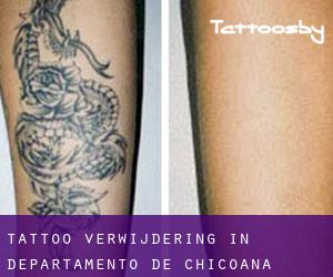 Tattoo verwijdering in Departamento de Chicoana
