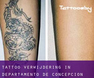 Tattoo verwijdering in Departamento de Concepción
