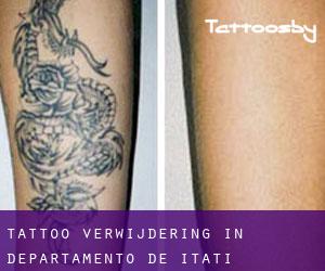 Tattoo verwijdering in Departamento de Itatí
