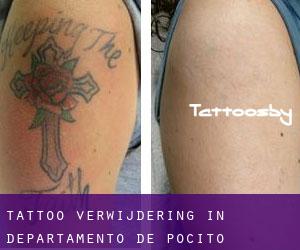 Tattoo verwijdering in Departamento de Pocito