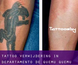 Tattoo verwijdering in Departamento de Quemú Quemú